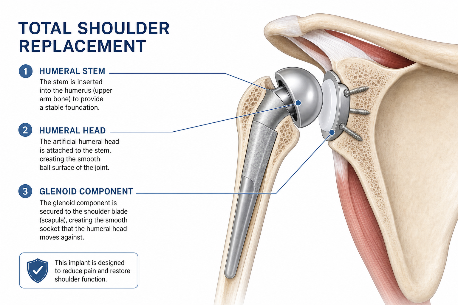 Anatomical illustration of total shoulder replacement implant components including humeral stem and glenoid