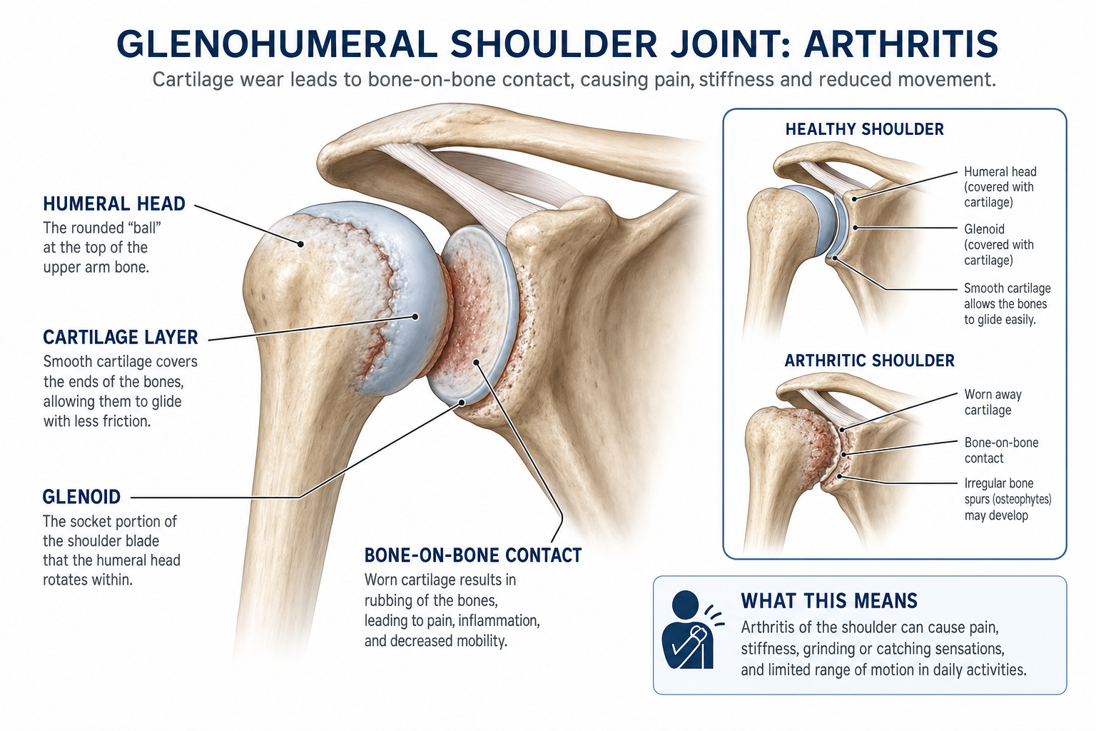 Anatomical illustration of glenohumeral shoulder arthritis showing cartilage loss and joint space narrowing