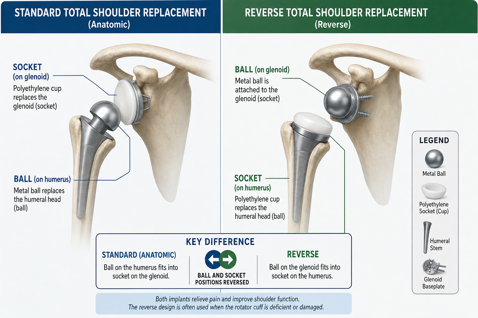 Diagram comparing standard shoulder replacement implant geometry to reverse shoulder replacement implant geometry