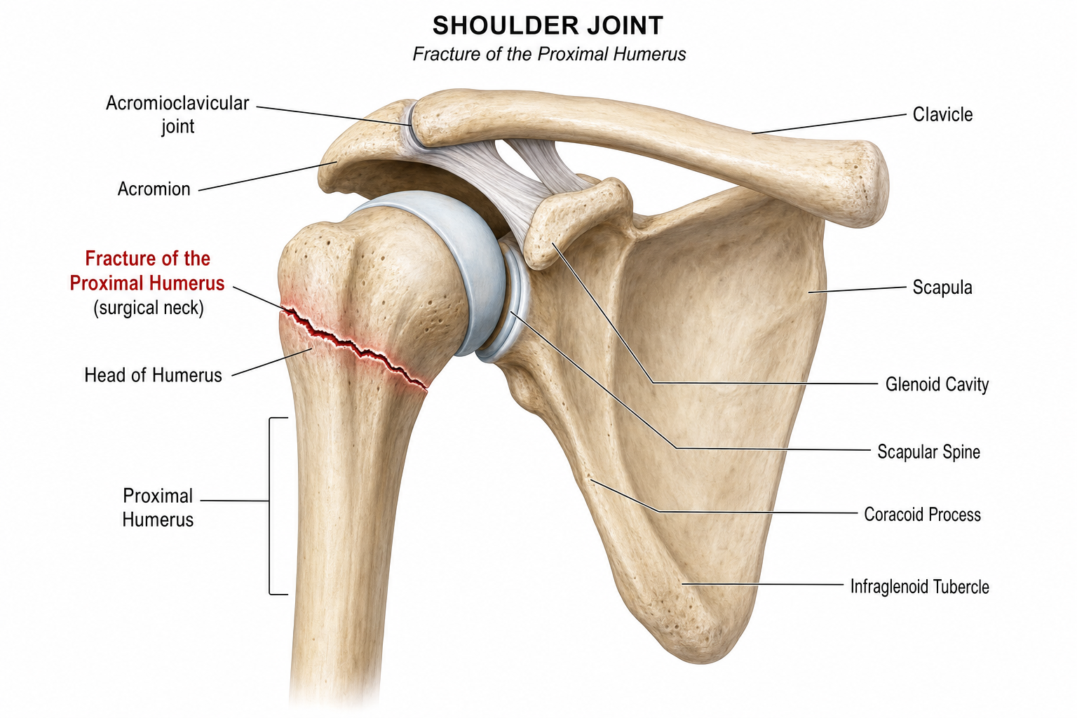 Anatomical illustration of a proximal humerus fracture at the shoulder joint