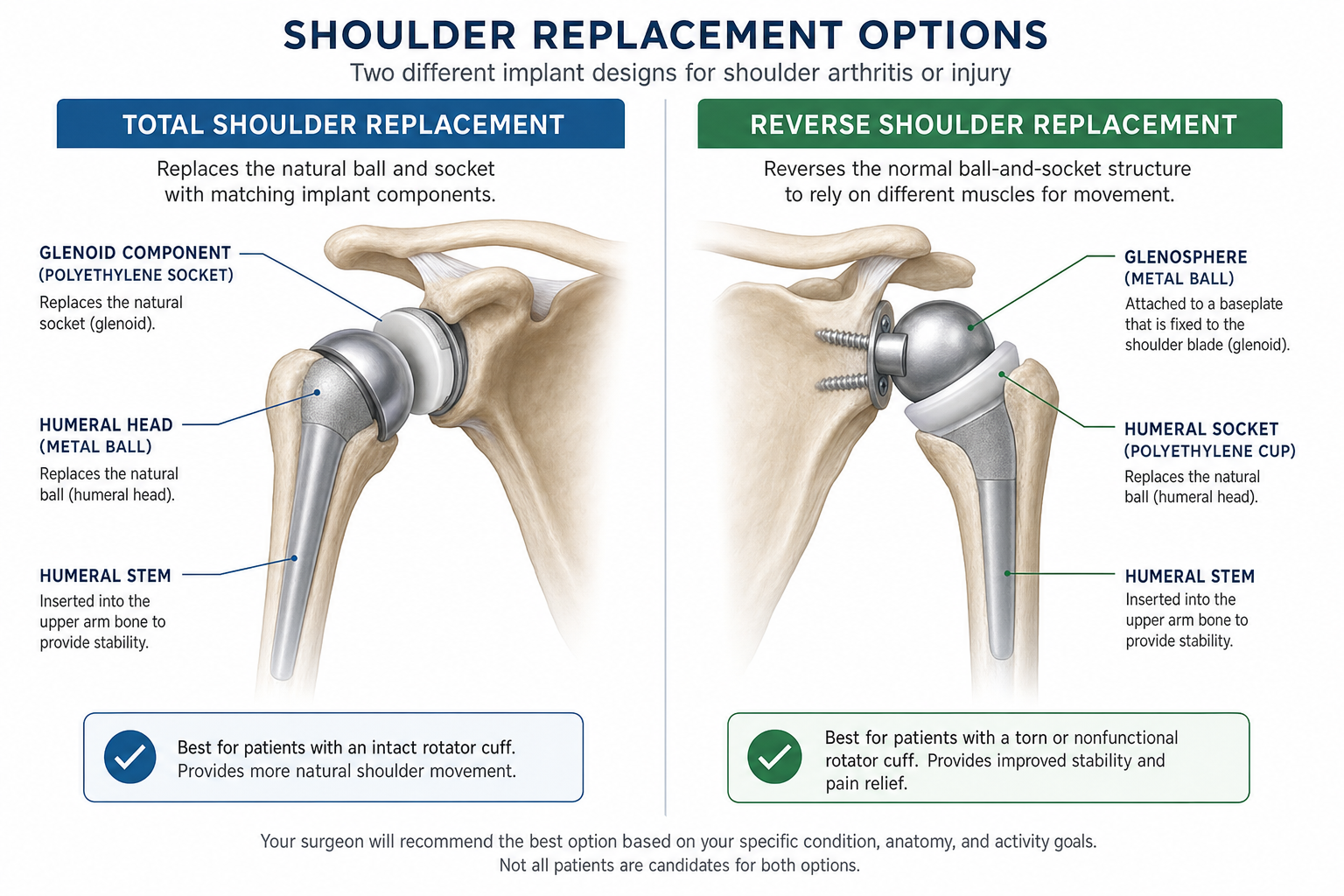 Medical illustration comparing total shoulder replacement and reverse shoulder replacement implant designs