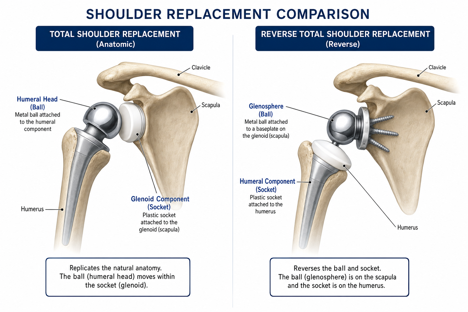 Anatomical illustration comparing total shoulder replacement and reverse total shoulder replacement joint configurations