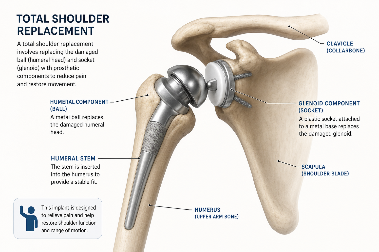 Anatomical illustration of a total shoulder replacement implant showing prosthetic ball and socket components