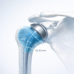 3D AI planning visualization for stemless shoulder replacement surgery showing bone preservation and implant positioning