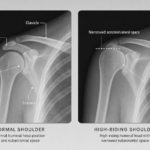 Two shoulder X rays side by side left normal with adequate subacromial space right high riding humeral head with narrowed space labeled anatomy