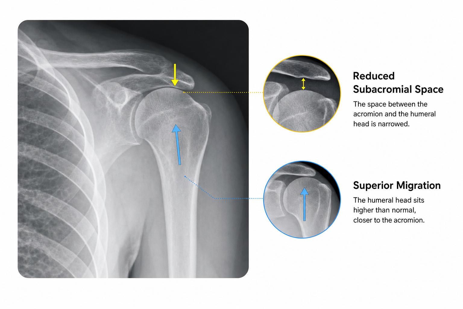 Annotated shoulder X-ray style image showing superior humeral head migration toward the acromion.