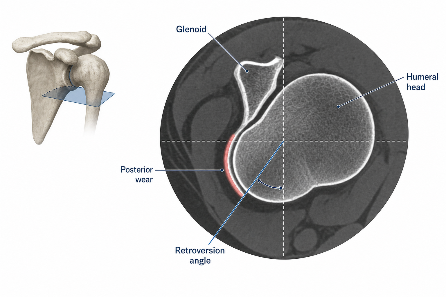 Illustration showing glenoid retroversion measurement on a shoulder CT scan